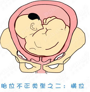 怀孕30周胎位不正头朝上怎么办,过了32周孕妇胎位还能调整吗