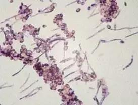 阴道假丝酵母菌感染什么症状,阴道假丝酵母菌感染症状