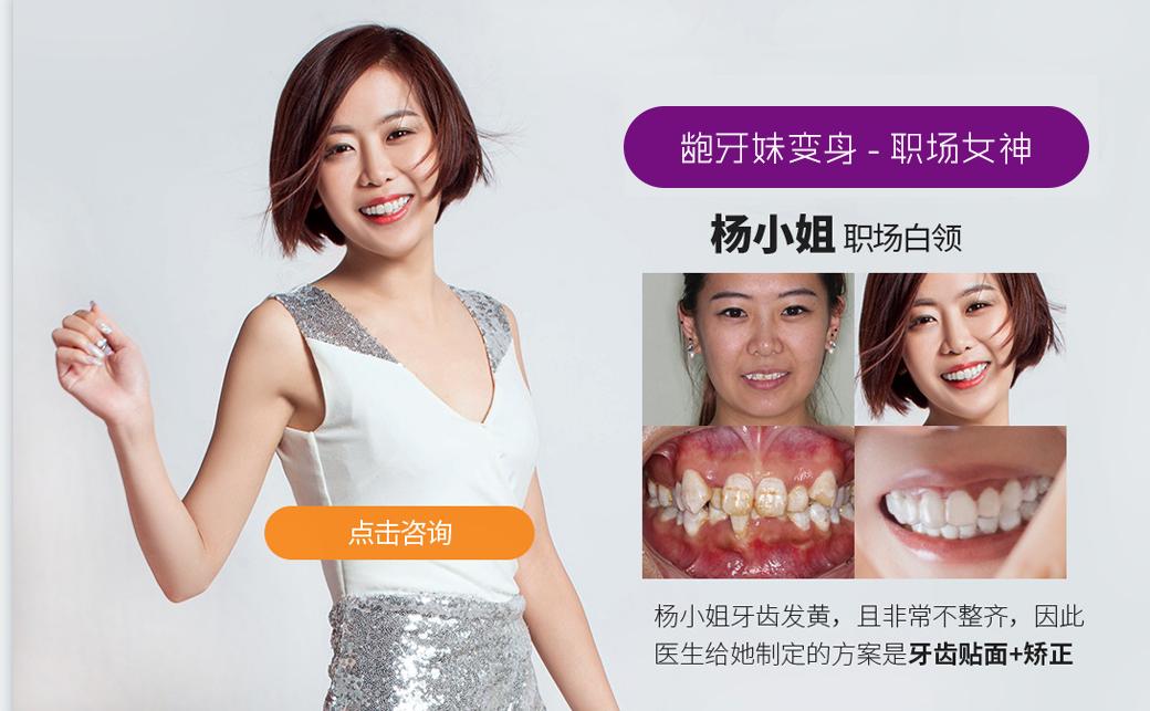 隐形矫正免费试戴,《芳华》女主也来打Call