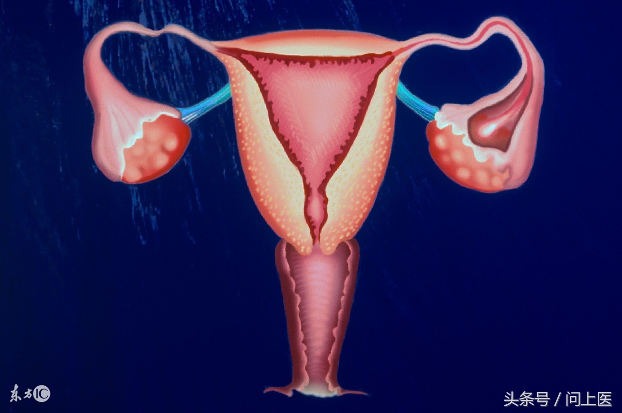 多囊卵巢避孕,避孕多囊