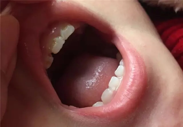 宝宝防奶瓶龋坏的方法,如何处理奶瓶龋齿图片视频