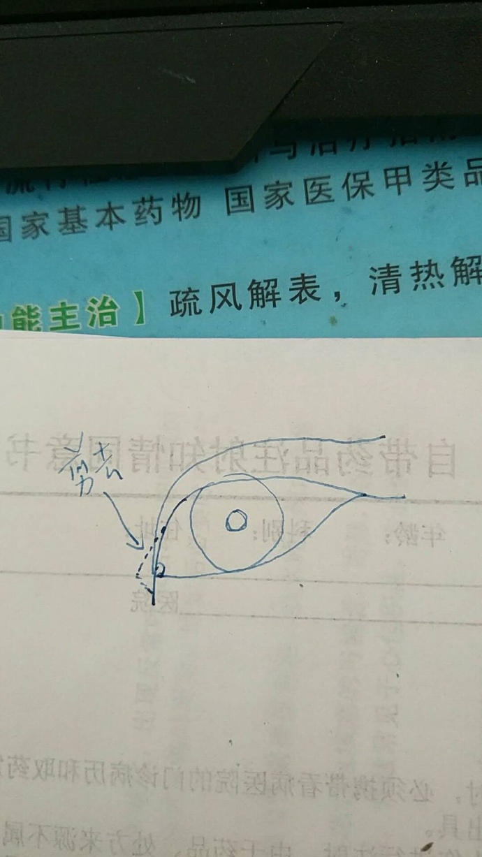 做过埋线还能做双眼皮切开手术吗,陈小剑做双眼皮案例