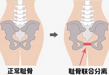 孕晚期耻骨疼痛难忍一招帮你缓解,孕37周耻骨疼走路都困难如何缓解