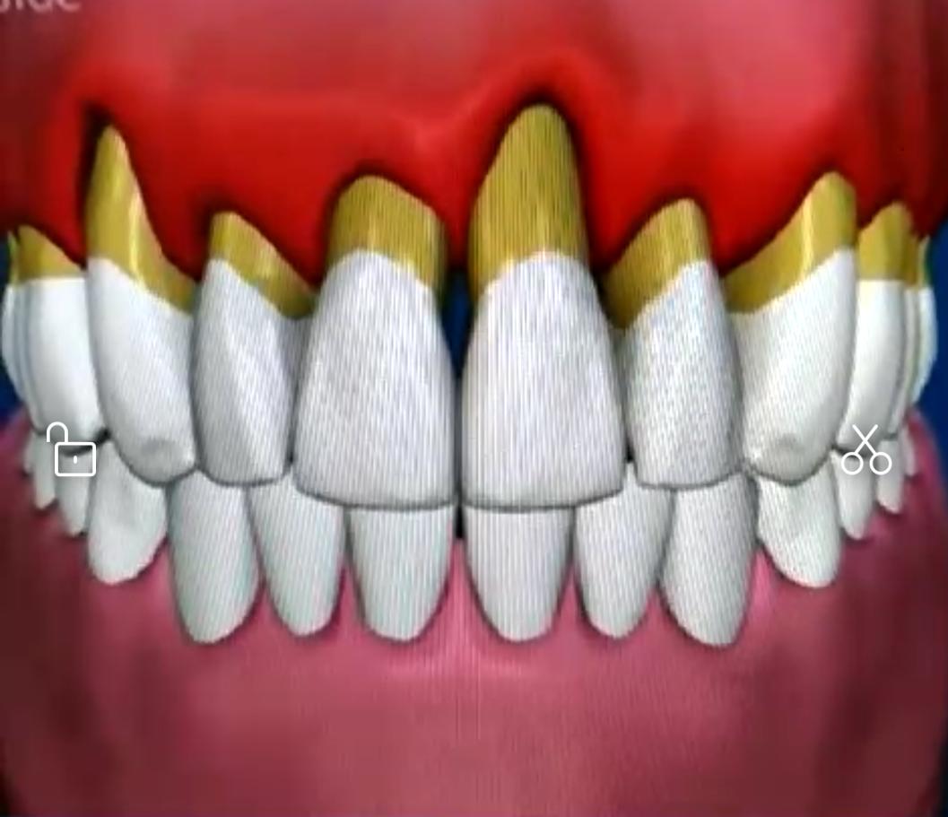 早期牙周病的症状,什么是牙周病及症状表现