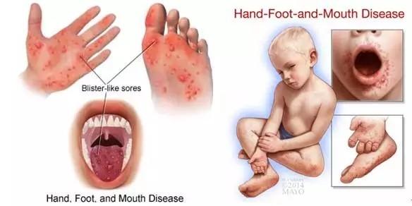 手足口病究竟是什么，如何科学防治？