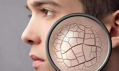 干燥综合征怎么治疗吃什么药,干燥综合征生活中注意什么