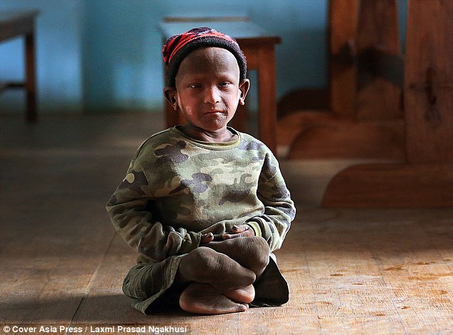 小男孩一出生就得到了一种怪病,男孩从小智力有残缺长大后被孤立