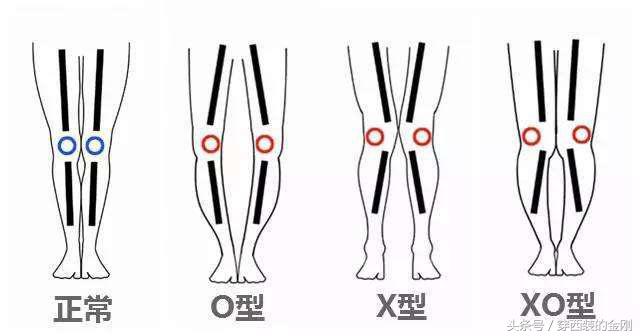 腿型问题怎么改善,o型腿怎样矫正不影响膝关节