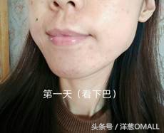 痘痘肌敏感肌混油皮区别,痘痘肌混油皮的面霜推荐