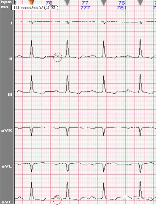 心电图课堂第22期,儿童心电图左室肥大怎么回事