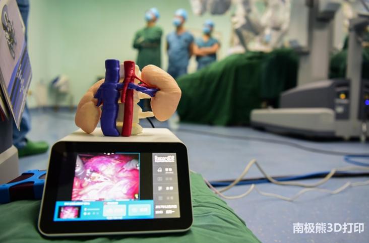 西安唐都医院，3D打印PEEK治愈胡桃夹综合征患者