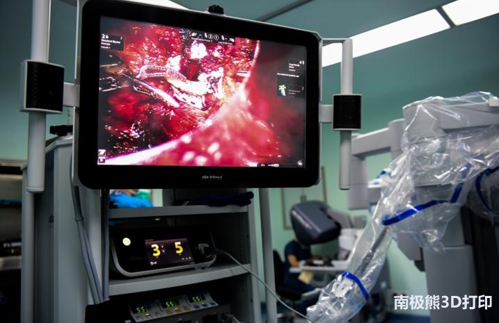 西安唐都医院，3D打印PEEK治愈胡桃夹综合征患者