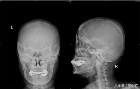 pagets能彻底治愈吗,pagets可以彻底治愈吗