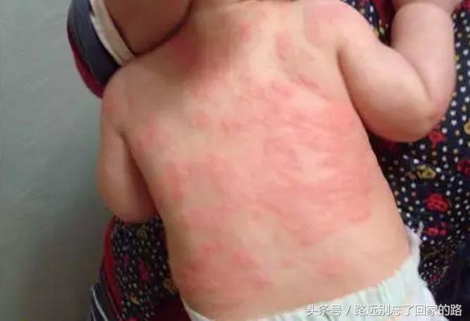 小儿过敏湿疹中医,婴儿湿疹和过敏有多大关联
