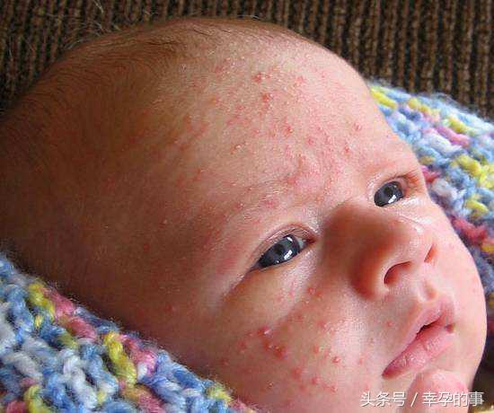 宝宝湿疹反反复复预防护理有技巧,宝宝湿疹总是反反复复怎么办