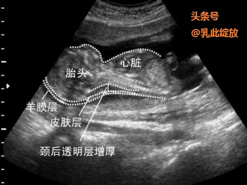孕早期nt检查标准,孕早期检查nt的范围是多少