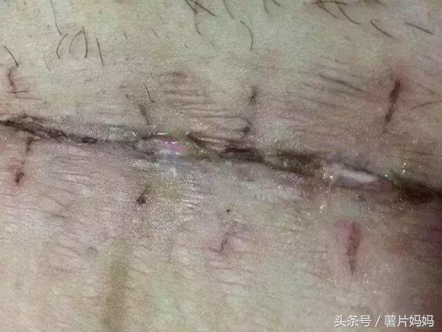 剖腹产六十天后伤口出血怎么回事,剖腹产60天了还流黄水怎么回事