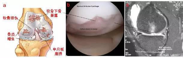 滑膜炎是肌肉还是骨头的问题,滑膜炎是不是类风湿的一种