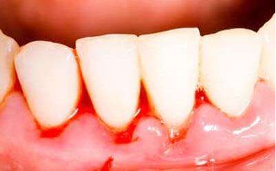 血液透析患者为什么二氧化碳低,血液透析患者为什么无尿