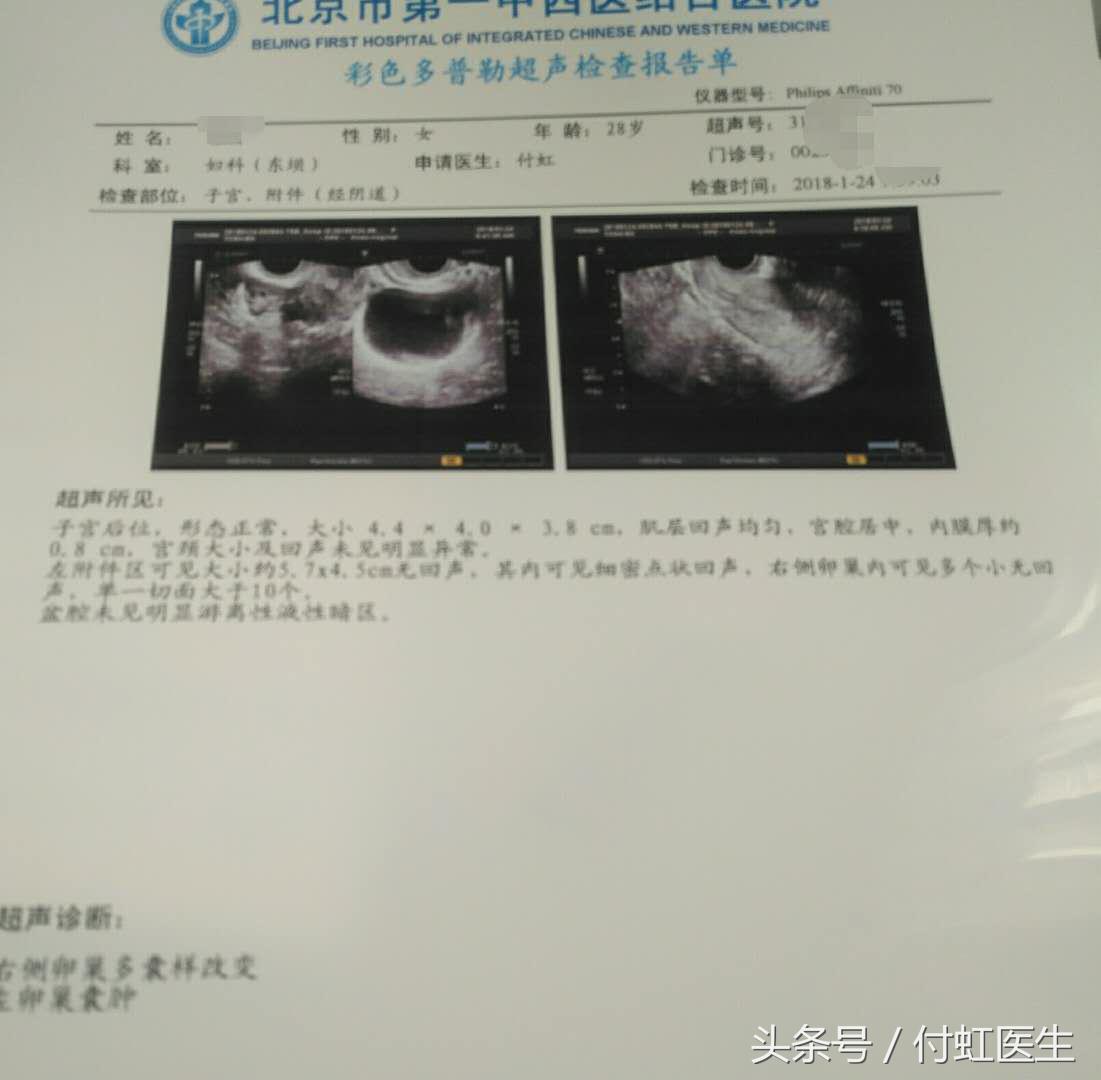 B超查出“多囊卵巢”，是导致我要不上宝宝的病因吗？
