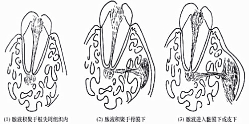 惊！根尖周病竟有这么大危害！中老年人成“重灾人群”！