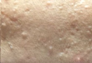 脸上和身上长了好的闭合性粉刺,青春期脸上长闭合性粉刺怎么办