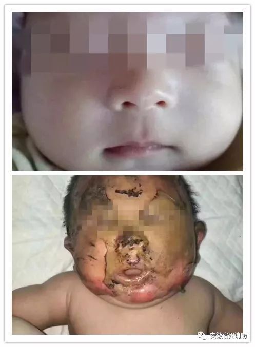 取暖器着火孩子冷静处理,婴儿被取暖器烤伤怎么办