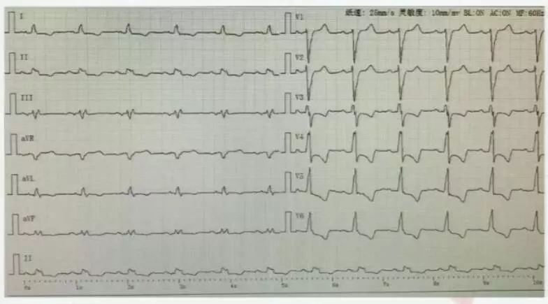 郑大一附院心血管内科专家陈英伟,房颤的治疗策略及进展