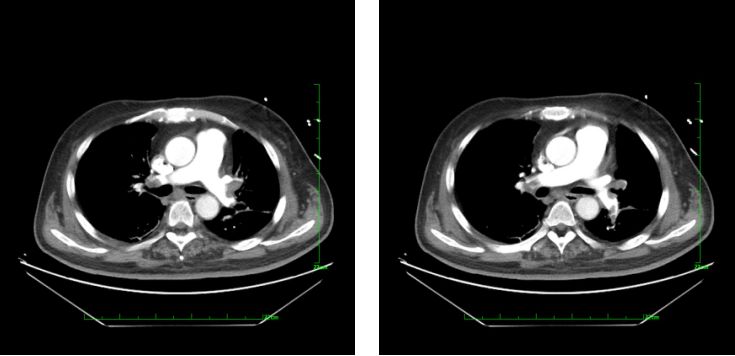 急性心梗病例讨论的意义,急性肺栓塞和急性心肌梗死