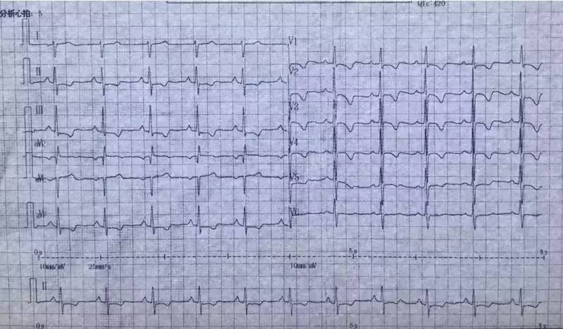 荆志成：特发性肺动脉高压1例