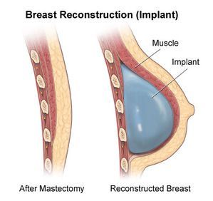 乳房全切和乳房重建能同时手术吗,乳房重建切口
