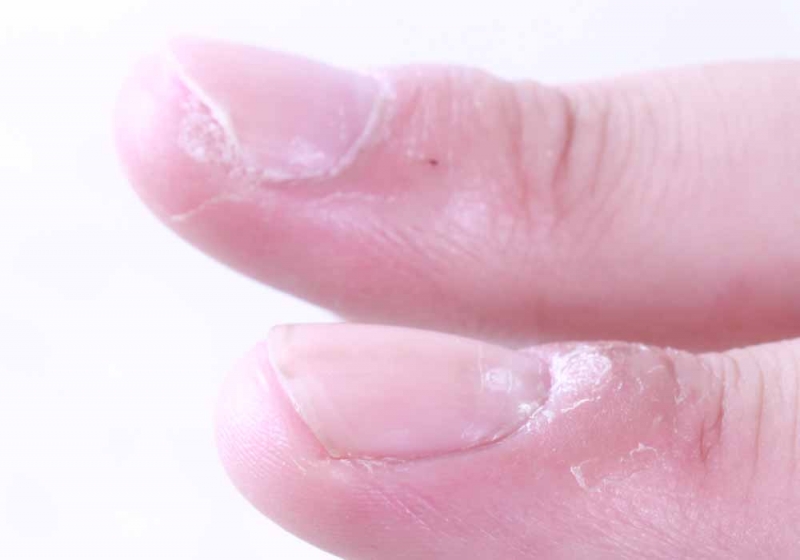 倒刺千万别乱撕严重可能被截肢,倒刺一直往下撕会怎么样