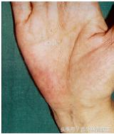 大肠癌化疗后抽血注意事项,大肠癌化疗完手无血色是咋回事