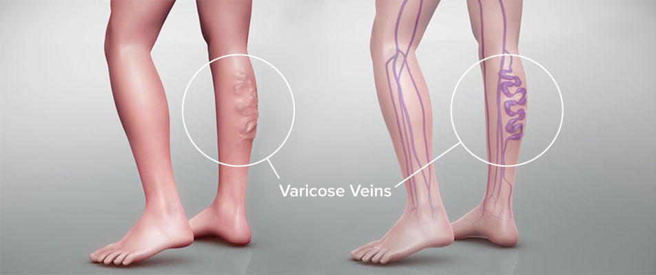 静脉曲张的微创治疗是怎么回事,治疗静脉曲张的新技术有哪些