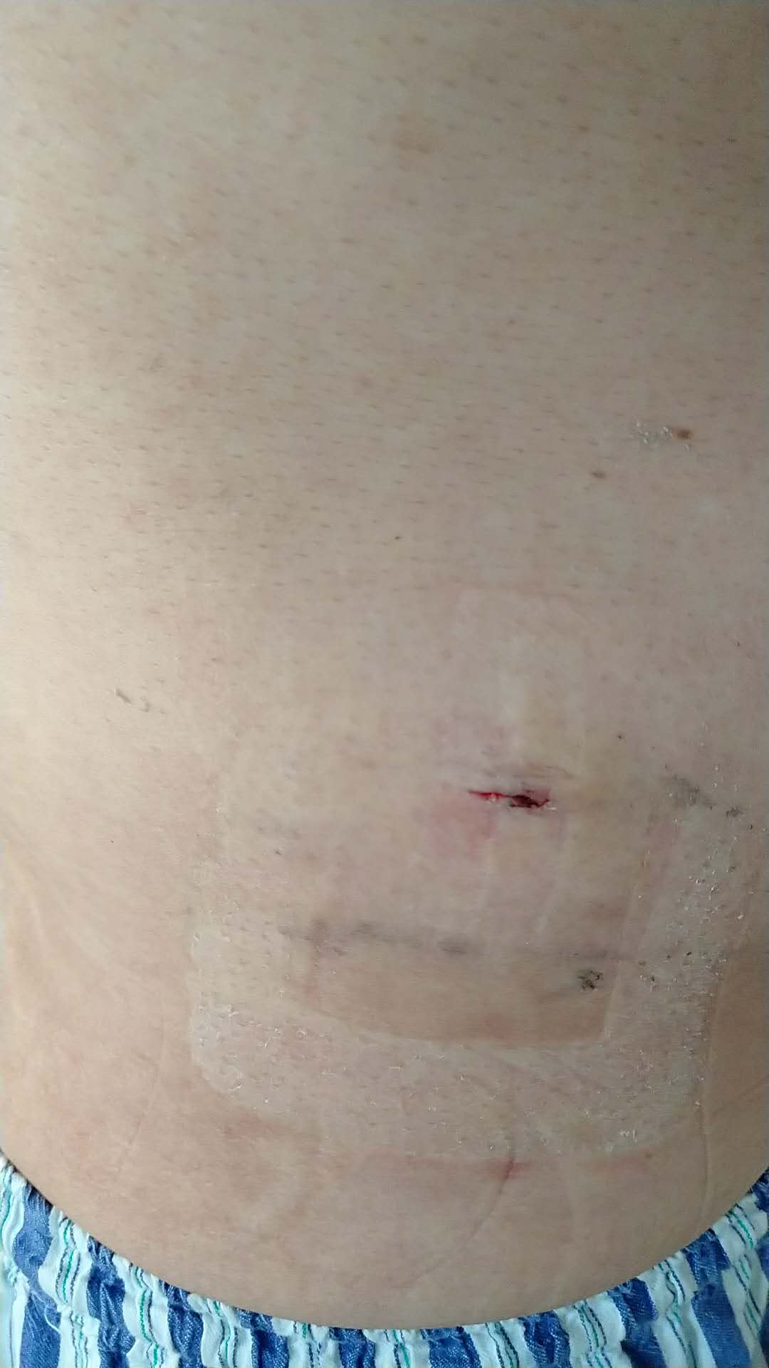 腰椎管狭窄的显微镜微创手术治疗,腰椎管狭窄椎间孔镜术后怎样康复