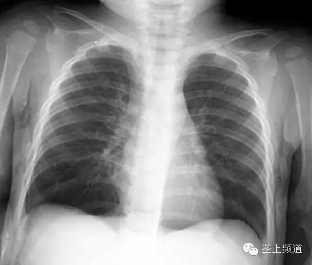 吓人吃瓜子竟然吃出病,嗑瓜子会导致什么病