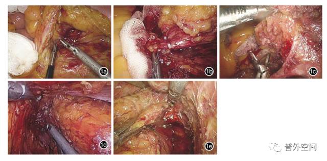 直肠癌手术后腹腔出血是怎么回事,荧光腹腔镜手术治疗直肠癌