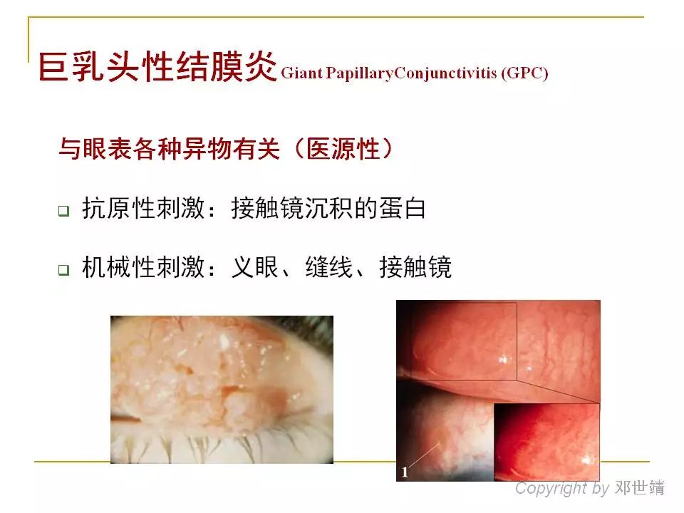 眼周过敏中医治疗,眼周过敏的症状图片