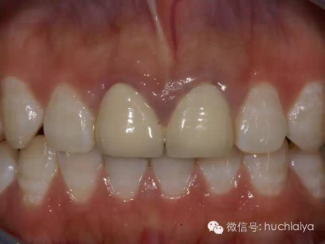 金属烤瓷牙不如全瓷牙好看