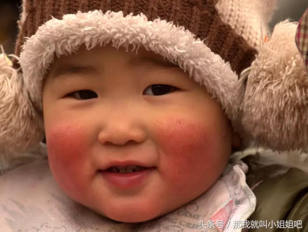 宝宝秋冬季红脸蛋的原因,宝宝秋冬红脸蛋怎么回事