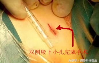 你说啥?手上多汗也要开刀?