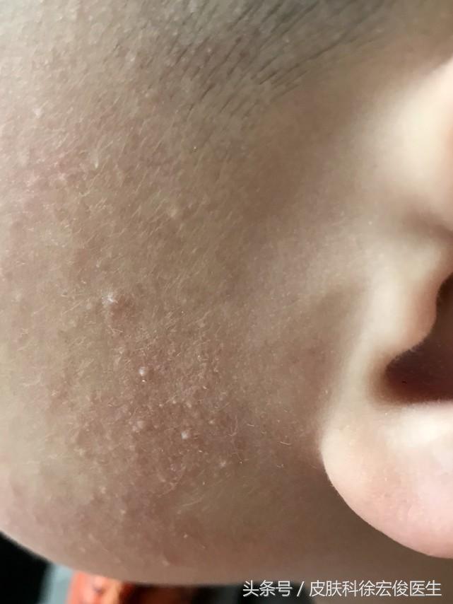 脸颊鸡皮肤显得脸色很难看,鸡皮肤太丑怎么办啊