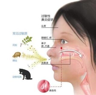 过敏性鼻炎和哮喘的关系,儿童过敏性鼻炎合并哮喘怎么治