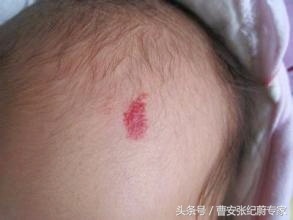 婴幼儿血管瘤常见的治疗方法,婴幼儿血管瘤的治疗方法