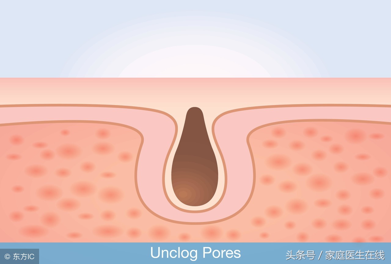 皮肤科医生教你如何去黑头,皮肤科医生告诉去黑头方法