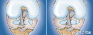 半月板损伤科普,膝盖半月板撕裂软骨脱落