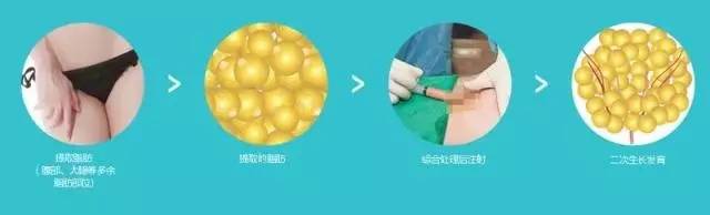 自体脂肪填充川字纹保持多久,自体脂肪填充10天内效果图