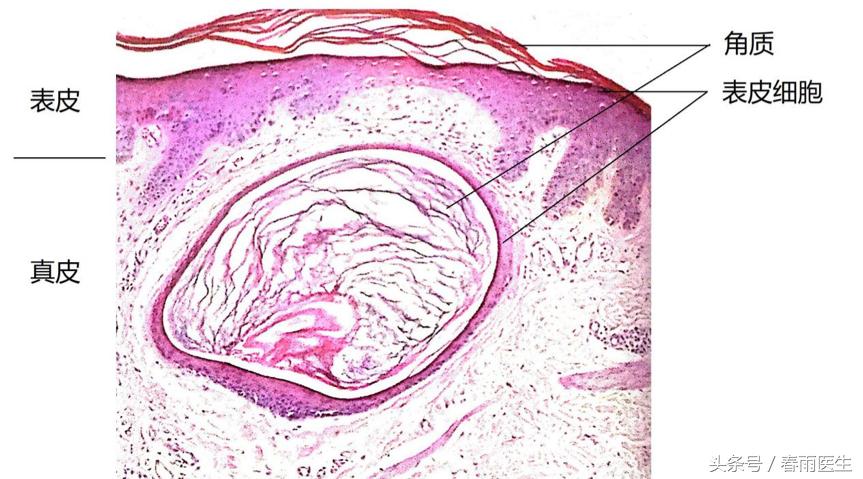 眼睛周围长脂肪粒该怎么洗脸,眼睛周围长脂肪粒是什么原因