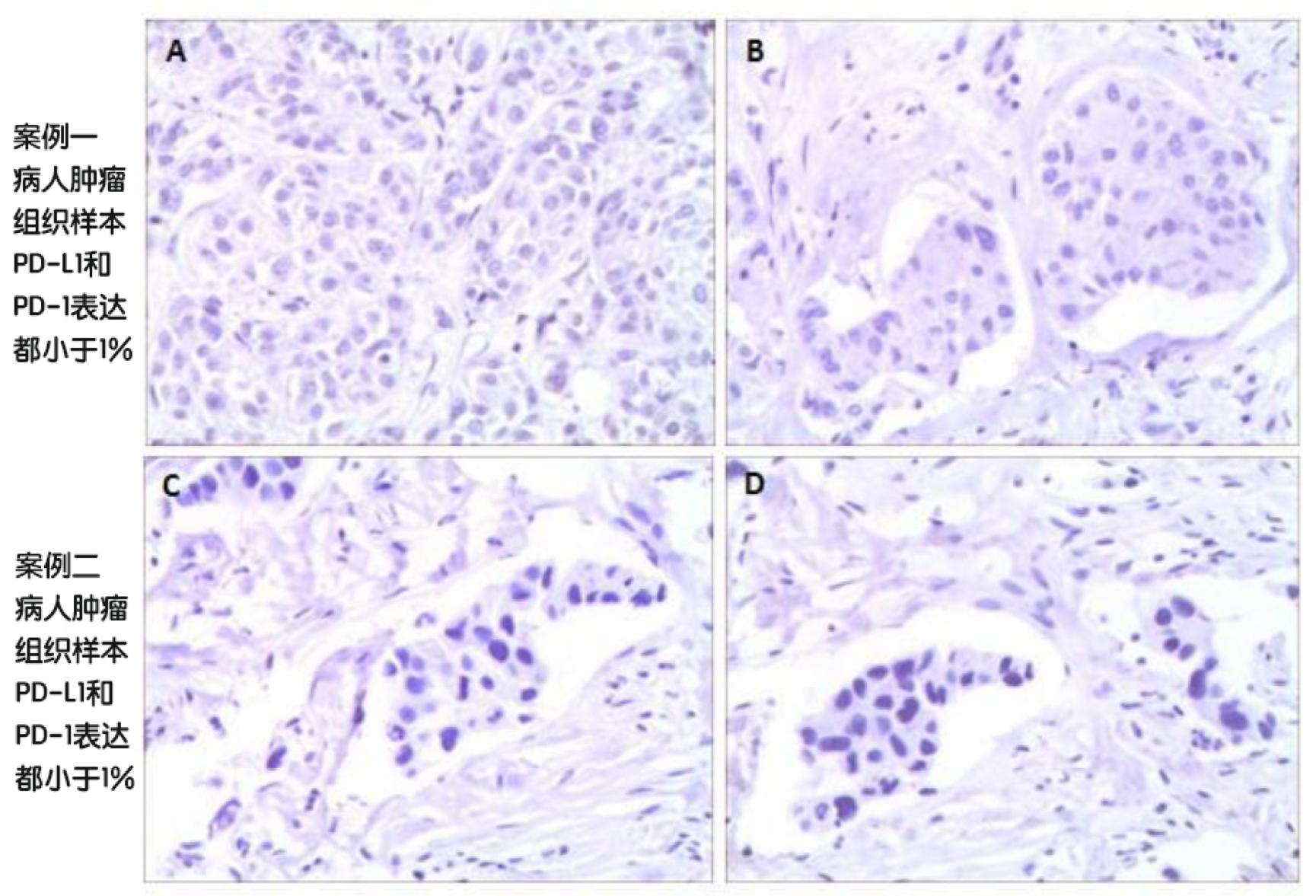 乳腺癌靶向药不耐药还会骨转移吗,乳腺癌肝转移靶向药耐药时间