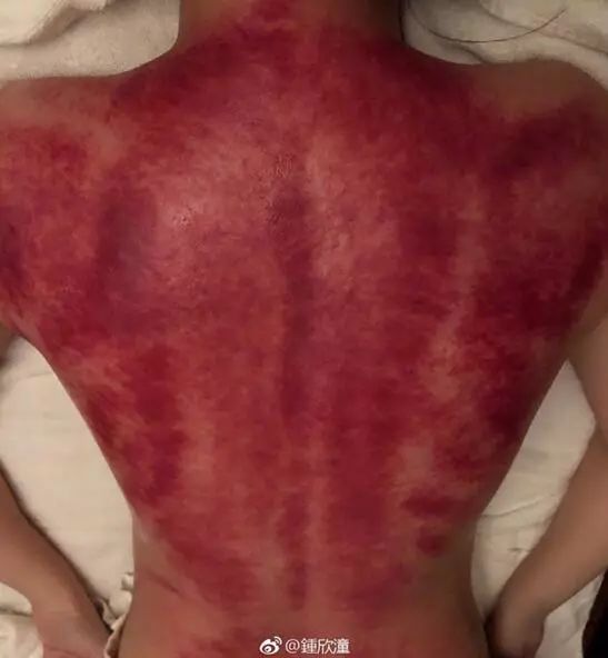 阿娇刮痧后背效果,阿娇背部刮痧图片